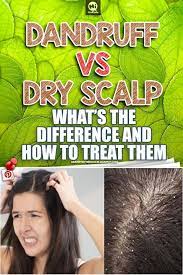 Many People Assume That Dandruff And Dry Scalp Are The Same Condition But Actually They Are Not It Is Very E Dry Scalp Remedy Dandruff Dry Scalp Hair Dandruff