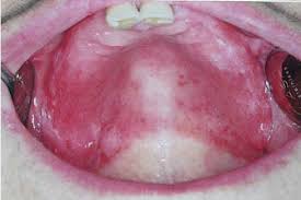 Image result for dermatitis contacta allergica