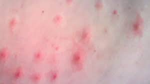 Image result for itchy skin rectum