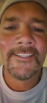 Life changing experience with bionic smile