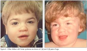Scarpa m, almássy z, beck m; Genetic Disorders Child With Unusual Appearance Inguinal Hernia Accelerated Growth And Developmental Delay Consultant360
