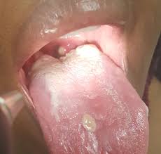 Hsv2, however, unlike hsv1, rarely causes other complications or spreads to different areas of the body outside of its original vicinity. Simultaneous Candida Albicans And Herpes Simplex Virus Type 2 Esophagitis In A Renal Transplant Recipient Bmj Case Reports