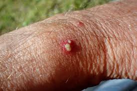 Image result for Fire Ant Sting