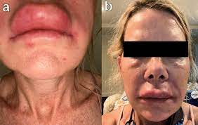 You can help by reporting any side effects you may get. Covid 19 Sars Cov 2 Virus Spike Protein Related Delayed Inflammatory Reaction To Hyaluronic Acid Dermal Fillers A Challenging Clinical Conundrum In Diagnosis And Treatment Springerlink