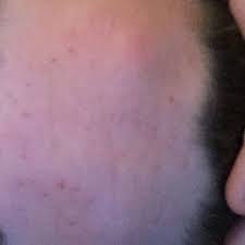 Dauerhaft Beule Am Kopf Was Tun Medizin Arzt Haut