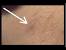Infected Ingrown Leg Hair