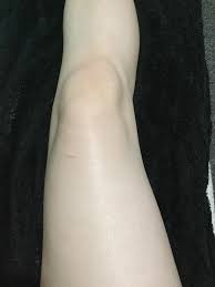 Regular exfoliation also helps ingrown hairs to grow correctly out of the hair follicle rather than curling back into the skin. Misc Stridex Saved My Legs From Razor Bumps And Ingrown Hairs Skincareaddiction