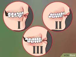 Estrabillo gives an overview on different types of malocclusions, along with what causes them, and ways they are corrected. 3 Ways To Diagnose An Overbite Wikihow