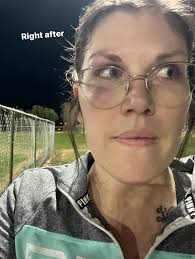 Eye protection crucial for preventing detached retinas