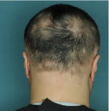 Three columbia specialties — dermatology, ophthalmology, and otolaryngology — are taking up residence in our expanded east side location at 880 3rd avenue. New Drug Said To Stimulate Regrowth Of A Full Head Of Hair In Just Four Months