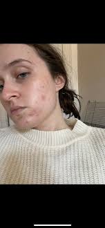 B&A] Semalam vs. pagi ni lepas guna high frequency wand sekali je! :  r/SkincareAddiction