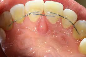 Jul 10, 2021 · how much is a permanent retainer? For Everyone Who Still Has A Permanent Retainer Chilling In Their Mouth