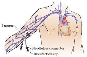 About Your Peripherally Inserted Central Catheter Picc