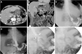 Early postoperative imaging after non-bariatric gastric resection: a primer  for radiologists