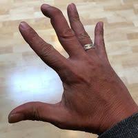 It can also happen after catching your finger on something. Mallet Finger Physiopedia