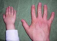 'it's genetic, i've had it my whole life. 10 Human Genetic Traits Of Simple Inheritance Which Do You Have