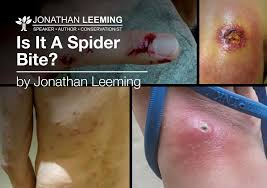 Image result for Spider Bite