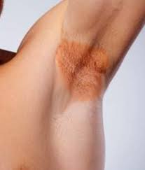 Image result for Erythrasma