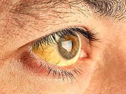 Ojos Amarillos Causas Mas Habituales Clinicas Ipoom Madrid