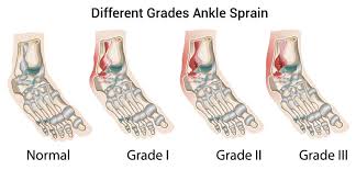 In ankle sprain case it is the ligament which gets sprained. Ankle Sprains Their Long Term Cost