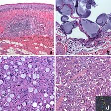 Recessed lighting installation necrotizing granulomatous inflammation. Non Infectious Granulomatous Lesions Of The Orofacial Region Springerlink