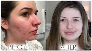The reef protected waters are ideal for snorkelling, kayaking, swimming with dolphins and a myriad of other water activities. Final Month Of Accutane Side Effects Weight Gain Regrets Youtube