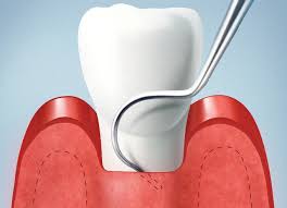Emergency root canal Lindenwold