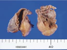 Endometriosis the blood is darker and gives the small foci of endometriosis the gross appearance of powder burns. Figure 1 From Endometrioid Adenocarcinoma Of The Ovary Arising In Atypical Endometriosis Semantic Scholar