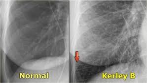 Pin On Thorax