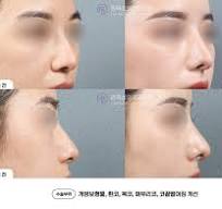 여자코성형후기 나에게 맞는 자려한 코 라인으로 : 네이버 블로그