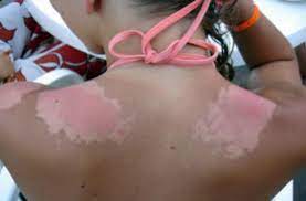 Premier réflexe indispensable après un coup de soleil : Melanome Les Coups De Soleil Dans L Enfance Font Bondir Le Risque