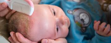 Check spelling or type a new query. Milchschorf Beim Baby Wie Sieht Die Behandlung Aus Kanyo