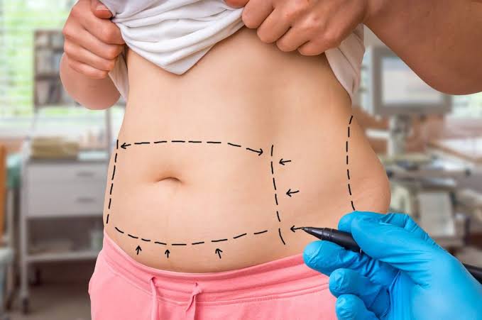 Best Tummy Tuck Dubai - Abdominoplasty Surgery In Dubai