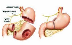 When the signs and symptoms of stomach cancer are not apparent, the disease may reach advanced stages before a diagnosis is made. Stomach Cancer Cost Treatment Surgery Top Hospital Best Doctors In India 2021