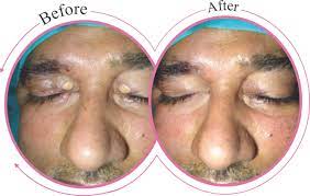 Xanthelasma is one of the most common cases dermatologists treat on a daily basis. Xanthelasma Treatment In Delhi Xanthelasma Removal Surgery