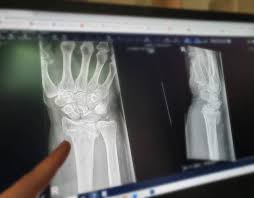 Image result for Wrist XRay