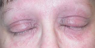 Talk with your doctor about your specific case of dermatitis. Eyelid Dermatitis Xeroderma Of The Eyelids Eczema Of The Eyelids Atopic Dermatitis Allergic Contact Dermatitis Irritant Contact Dermatitis Seborrheic Dermatitis Of The Eyelids Dermatology Advisor