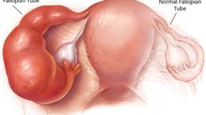 HYDROSALPINX – Dr Gan Kam Ling