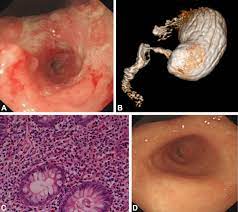 Most of the time, a virus is the culprit, in which case the illness is known as viral gastroenteritis. Severe Eosinophilic Gastroenteritis Gastrointestinal Endoscopy