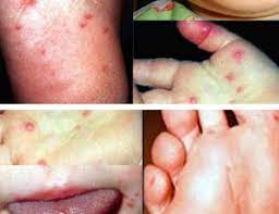 Penya penyaki kitt tang tangan an,, kaki kaki dan dan mulu mulutt iala ialah h penyak penyakit it berjan berjangki gkitt yang yang sederh sederhana ana. Sakit Kuku Kaki Tangan Dan Mulut Klinik Dr Rushmini