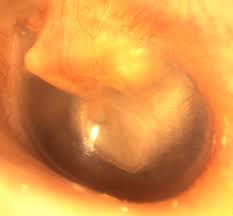 Les causes courantes des bosses derrière les oreilles incluent les abcès, la dermatite, le cancer, les kystes sébacés, la lymphadénopathie, l'acné vulgaire, l'infection de la gorge, la mastoïdite, l'otite moyenne. Le Cholesteatome Otologie Dr Albert Mudry