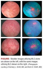 Role Of Blue Light Cystoscopy To Detect Bladder Cancer Urology Times