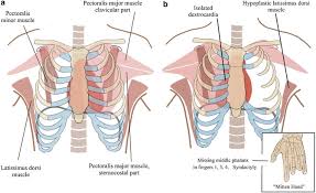 People generally have normal movement and health. Poland S Syndrome Thoracic Key
