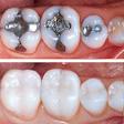 Tooth Fillings