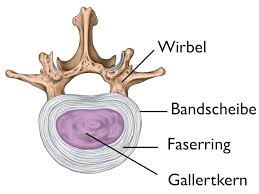Bei einem bandscheibenvorfall bricht der sog. Bandscheibenprotrusion Das Hilft Dir Bei Einer Vorwolbung Der Bandscheiben Liebscher Bracht