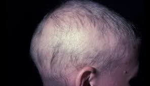 Image result for Alopecia
