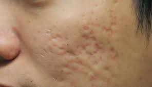 Ada beberapa bahan alami yang dapat anda gunakan untuk menuntaskan masalah jerawat pada kulit. Cara Mencegah Bekas Jerawat Pada Pria Agar Tidak Parah Pure Laser Clinic Indonesia