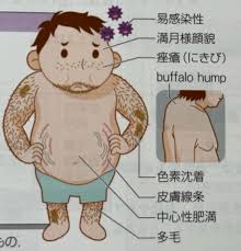 プレドニン 離脱 症状 ブログ