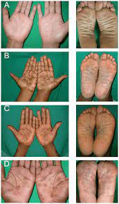 They develop about 3 weeks after someone is infected. Palmar And Plantar Rash Of Secondary Syphilis Typical Palmar And Download Scientific Diagram