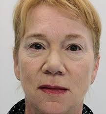 Scarlet Microneedling Lifts à Montréal